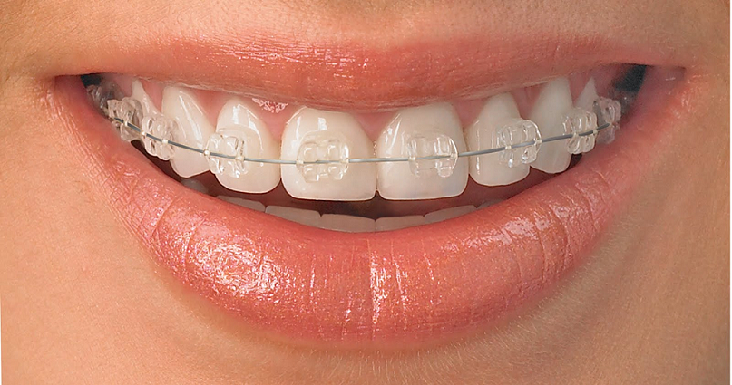 aparat dentar safir